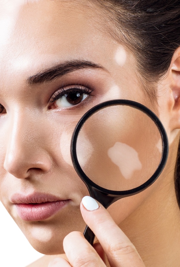 طرق طبيعية لعلاج البهاق في الوجه نهائياً