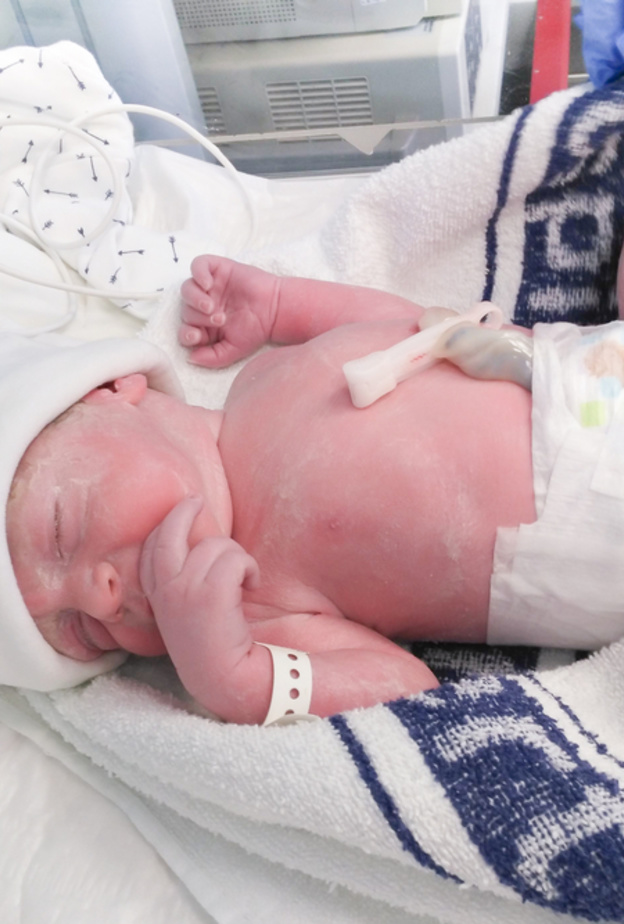 اضرار الولادة القيصرية على المدى البعيد قد تصيب الطفل بالربو والبدانة خلال مراحل نمو المتطورة