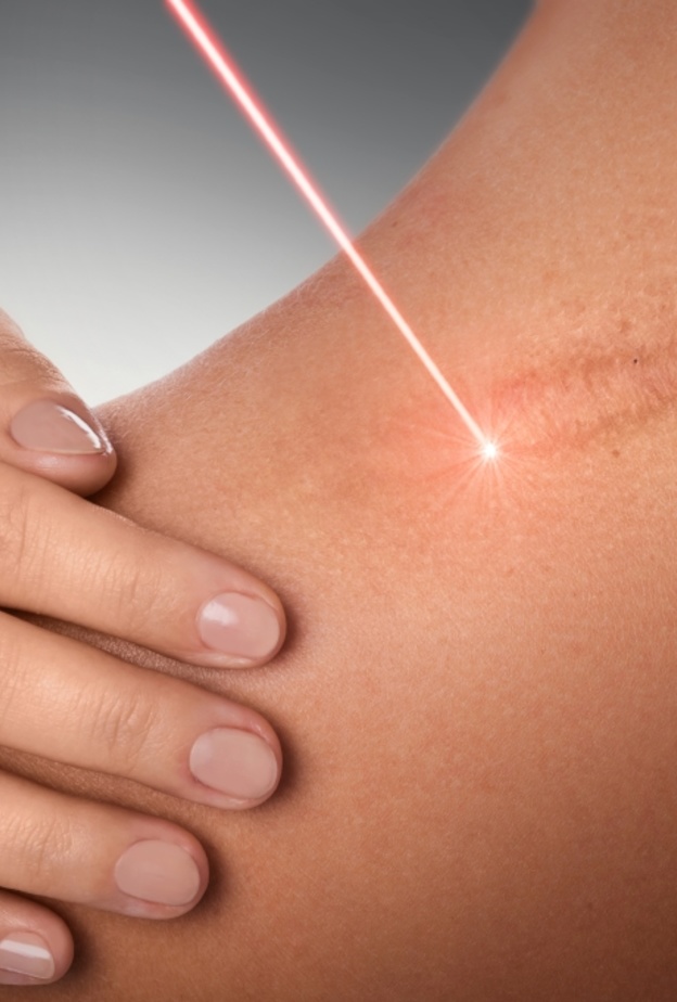 الليزر هي واحدة من أكثر العلاجات شيوعاً للتخلص من آثار الحروق