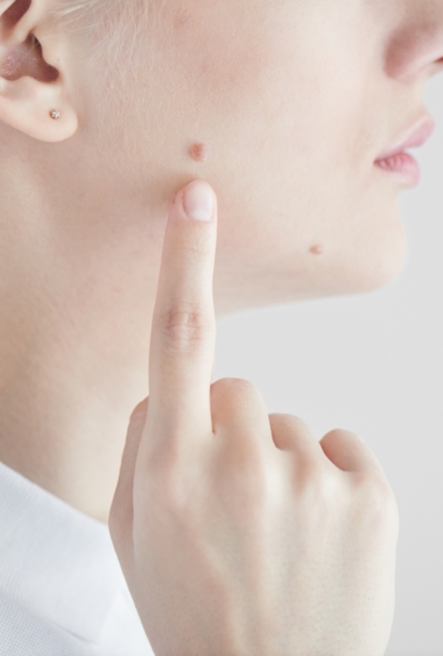 خل التفاح يساعد على التخلص من الشامات بشكل سريع