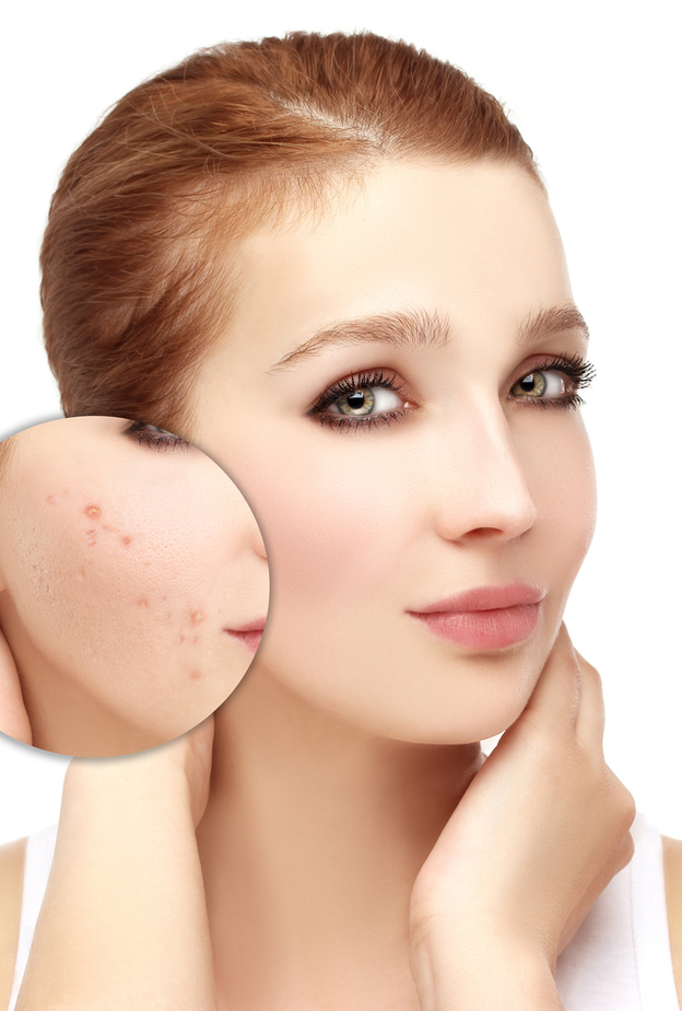 وصفات من زيت جوز الهند لإزالة حب الشباب من البشرة