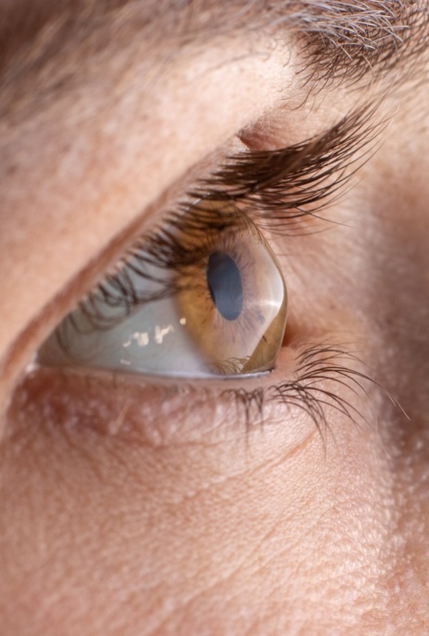 القرنية المخروطية احد مشاكل العيون الشائعة