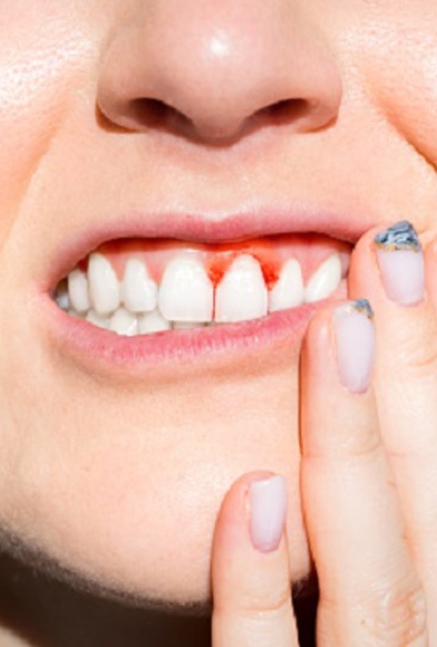 دراسة: ما العلاقة بين التهاب اللثة وأمراض القلب