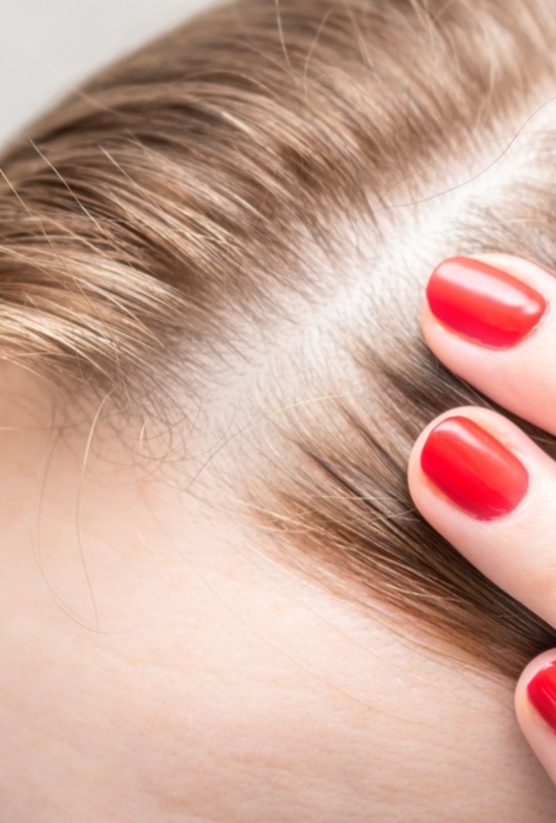 مرض الثعلبة ناجم عن عدوى فطرية تصيب فروة الرأس