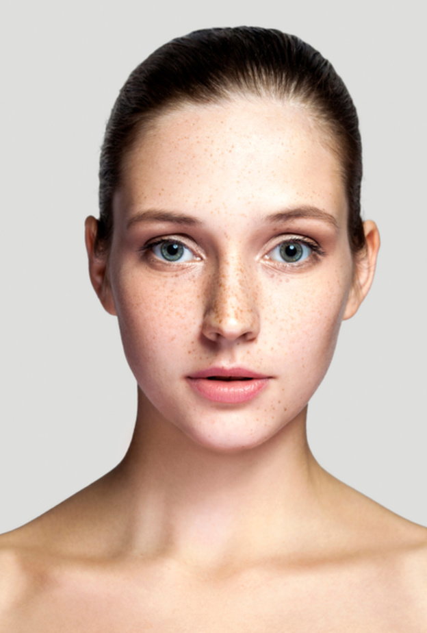 طرق إزالة النمش من الوجه تجميلياً وما هي نتائجه