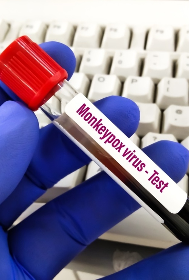 اهم اعراض جدري القرود وطرق الوقاية منه