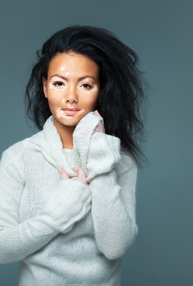 البهاق مرض يصيب الجلد ويتسبب بظهور بقع بيضاء