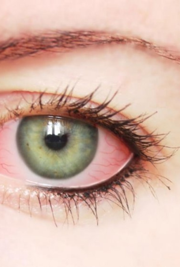 التهاب العين البكتيري اسبابه واعراضه وطرق الوقاية منه