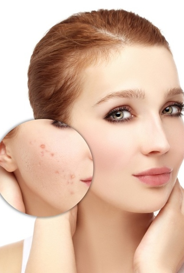 علاج حب الشباب بالوصفات