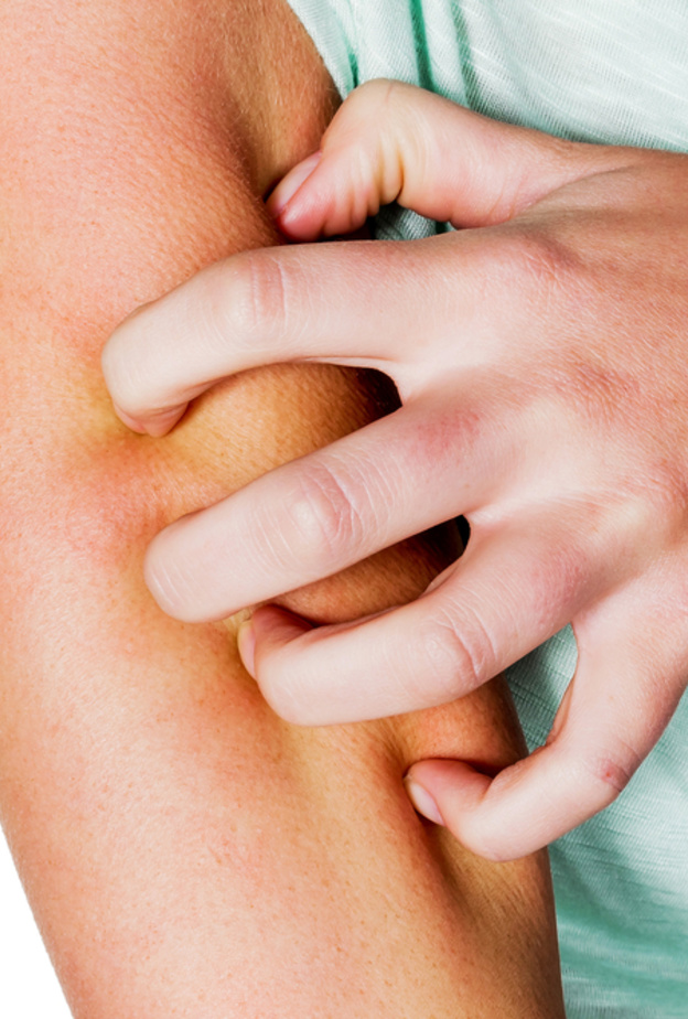 الحكه نتيجه لدغه الباعوض