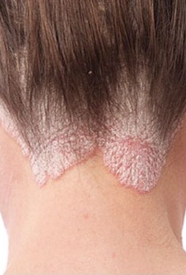 الصدفية في فروة الرأس