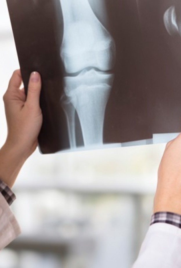 هشاشة العظام