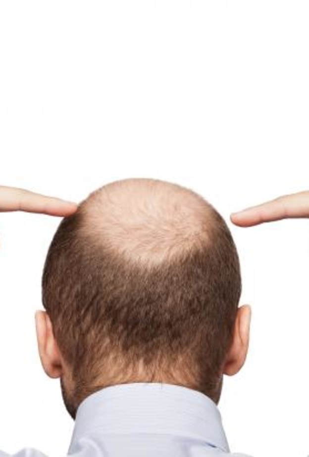 الصلع عند الرجال