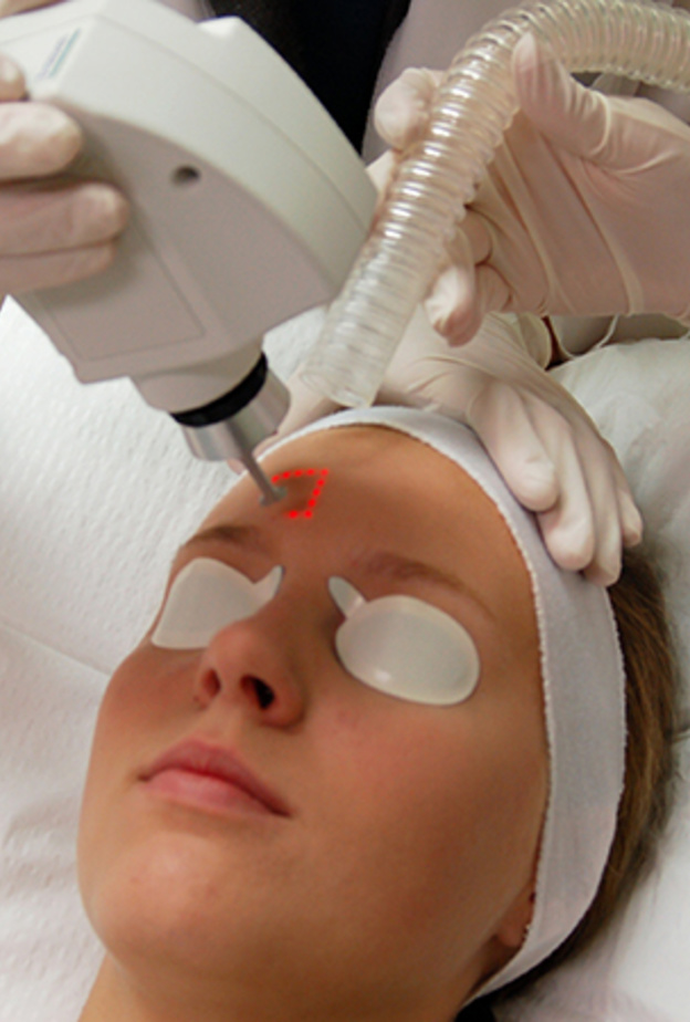 علاج الوحمات و الشامات  بالليزر