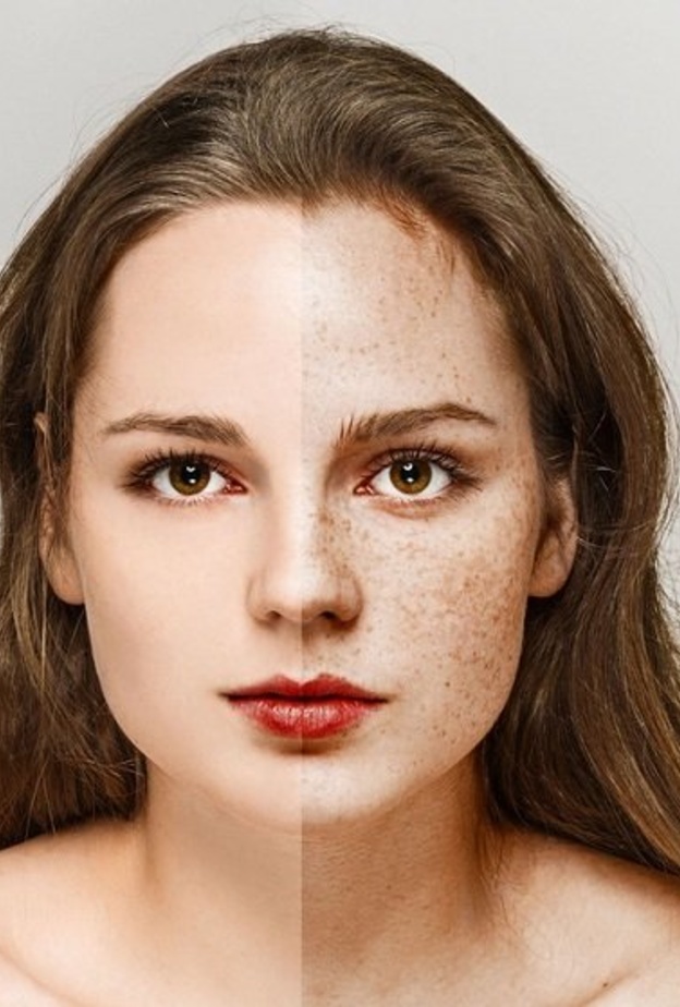 تخلصي من النمش والكلف بالوصفات الطبيعية