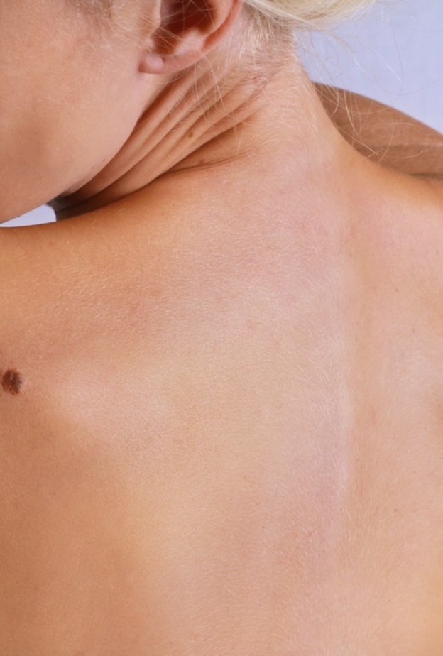 انواع سرطان الجلد واسباب الاصابه وطرق العلاج منه