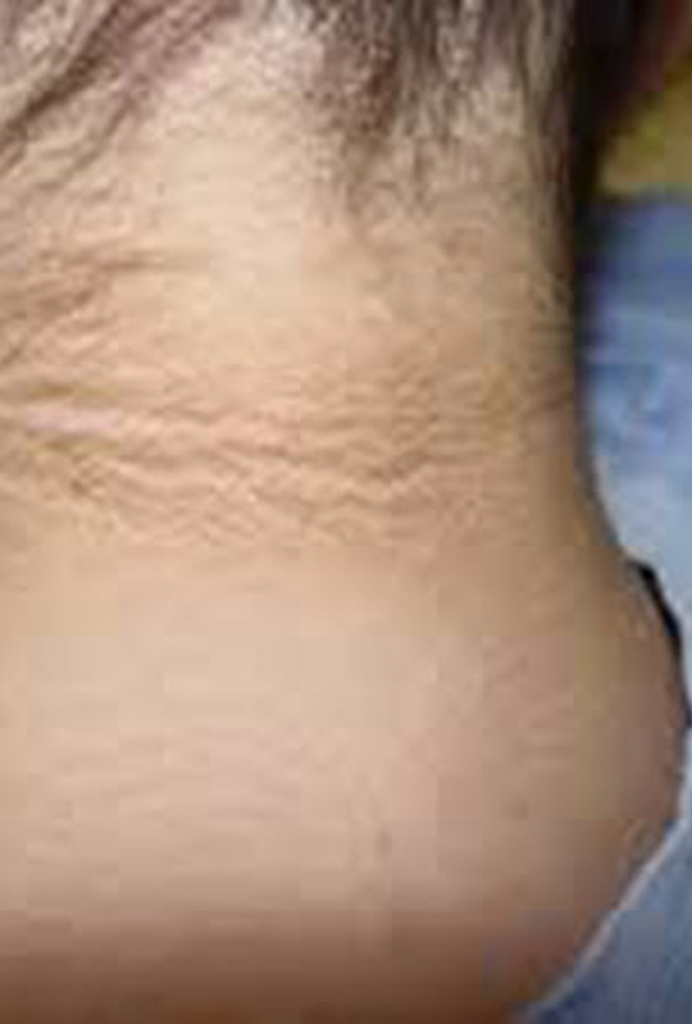 البقع السوداء التي تشير لاحتمال الإصابة بالسكري من النوع الثاني