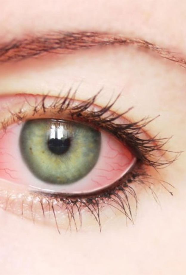 نزيف العين يحدث نتيجة الإصابة بإلتهابات العين.