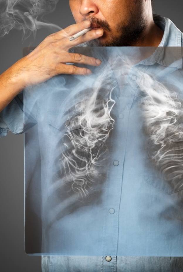 التدخين من ابرز اسباب الاصابة بسرطان الرئة