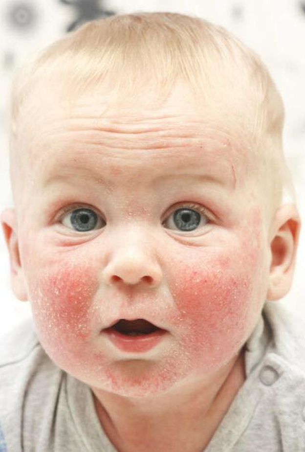 5 امراض جلدية تصيب الاطفال الرضع