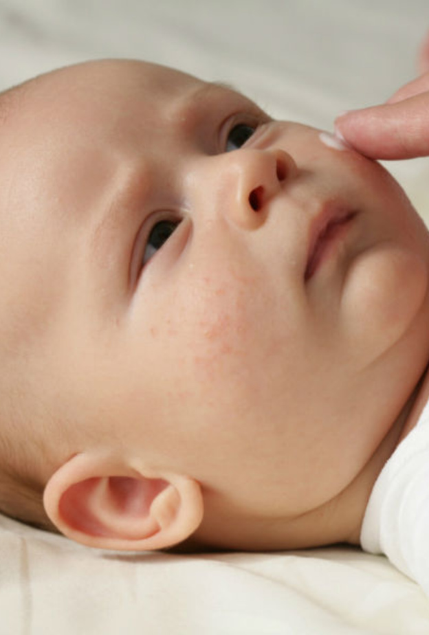 اعراض القوباء الحلقية عند الاطفال