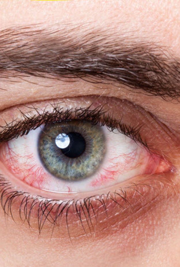 ما هي اعراض جفاف العين