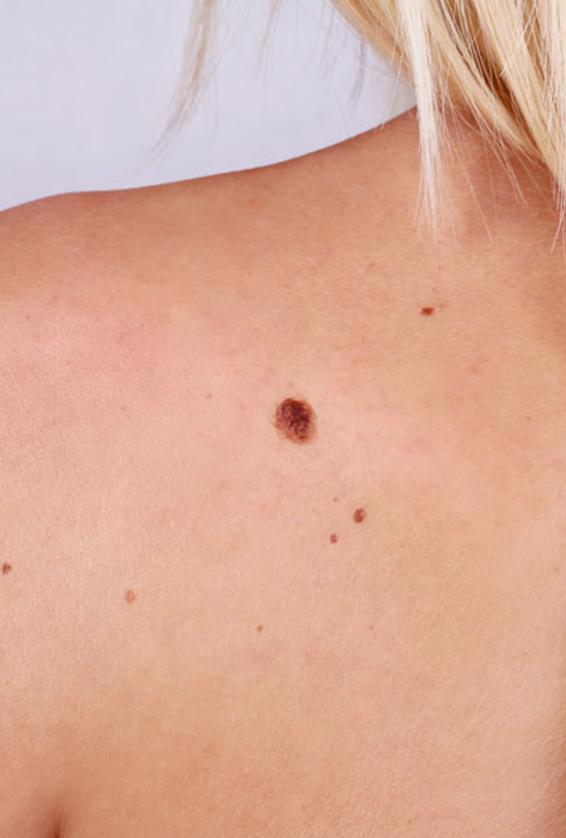 اعراض سرطان الجلد المبكرة