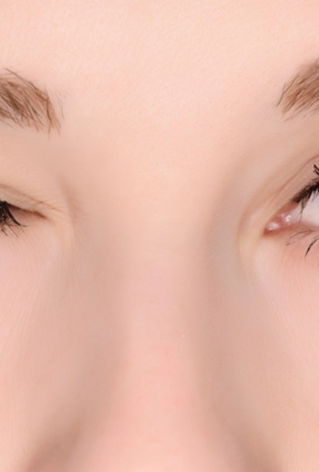 مرض القرنية المخروطية عند الشباب