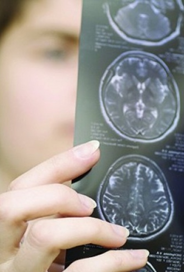  التصلب اللويحي هو التهاب أغشية الدماغ