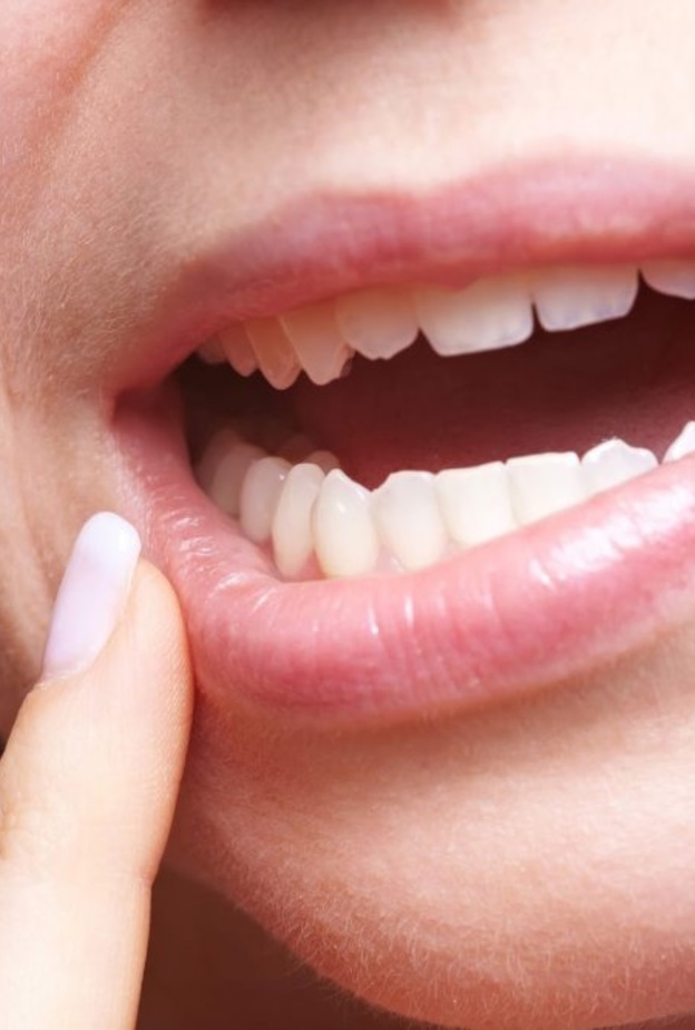  السكري يسبب التهاب اللثة.