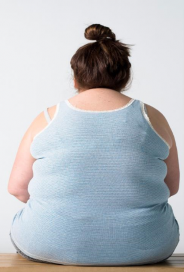 السمنة ثاني أكبر مسبب للسرطان في العالم