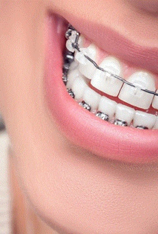 التقويم يعالج بروز الأسنان ويجملها