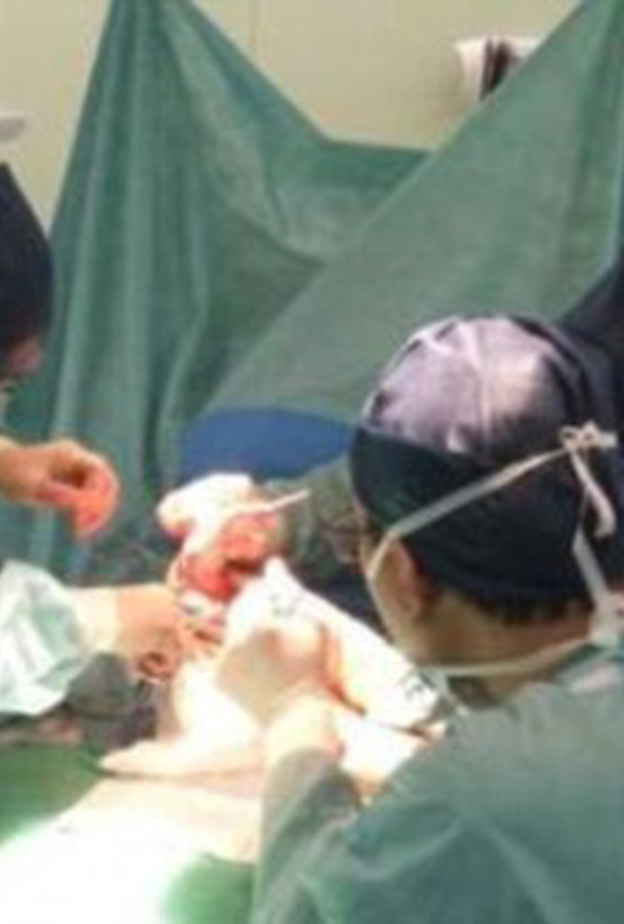 إزالة الرجل الزائدة في أول تدخل جراحي للطفل