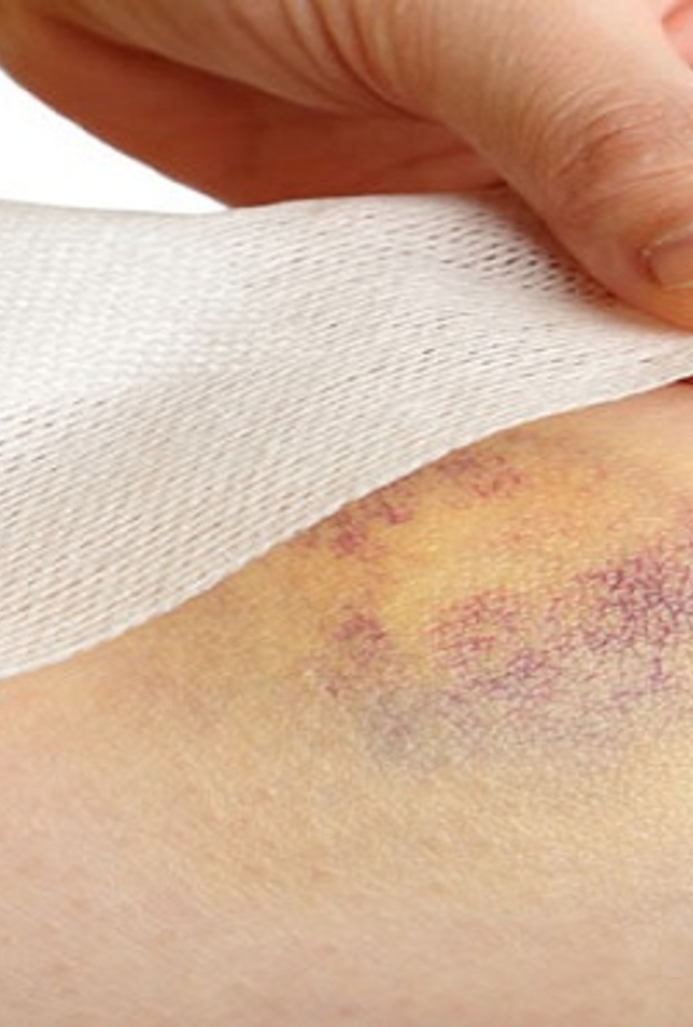 الكدمات يمكن علاجها بكمادات الماء الساخن