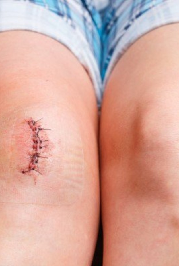 عملية استبدال مفصل الركبة تحتاج إلى تأهيل تدريجي