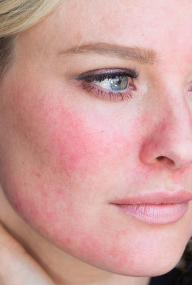  الذئبة الحمراء مرض مناعي مزمن