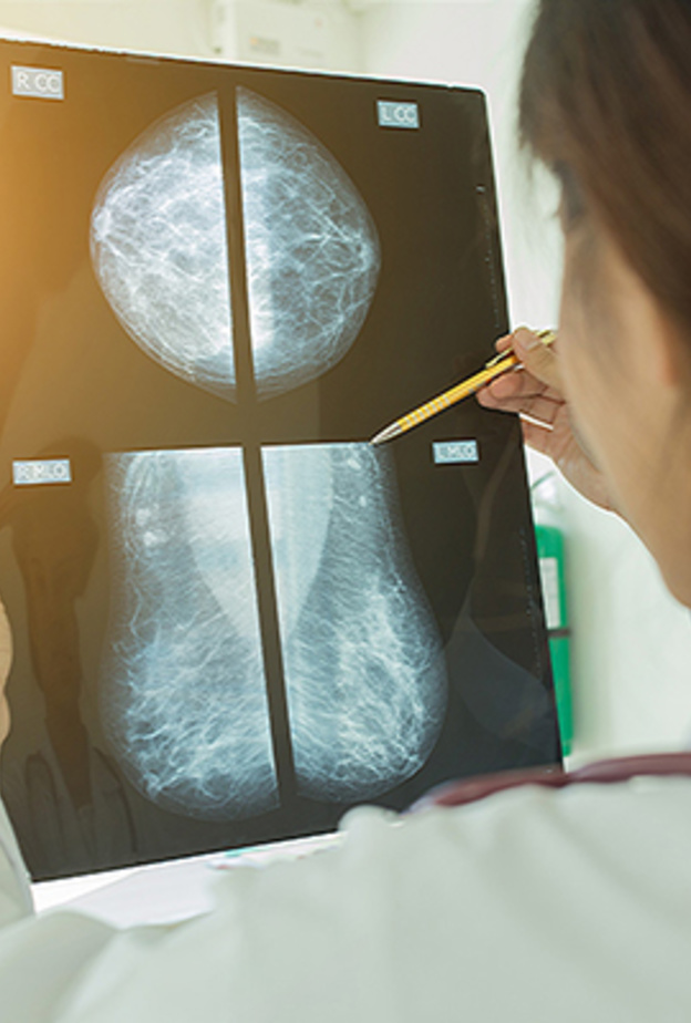 الماموجرام تكشف عن سرطان الثدي في أول مراحله