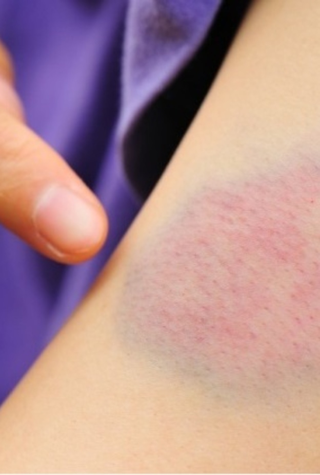 الكدمات من علامات فشل نخاع العظم