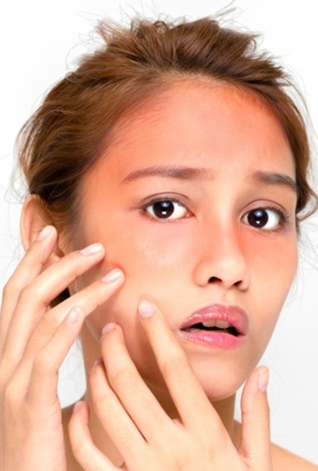 علاج  حروق الشمس