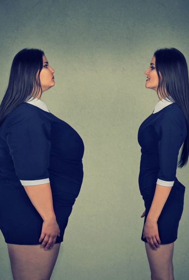 عملية تحوير المعدة تعالج السمنة المفرطة