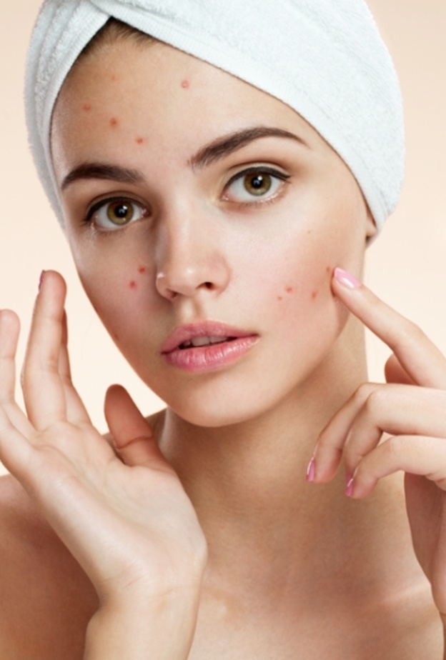 زيت شجرة الشاي يستخدم لعلاج حب الشباب