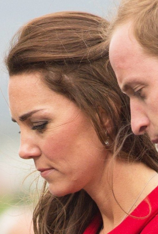 ما سر الندبة الصغيرة التي توجد على رأس كيت ميدلتون؟