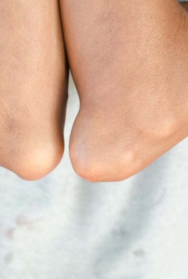 مرض النقرس يسبب آلام وتشوهات في المفاصل و العظام