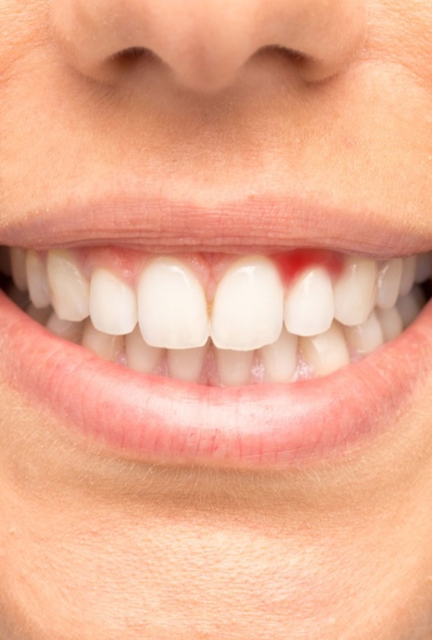 طرق منزلية لعلاج نزيف اللثة 