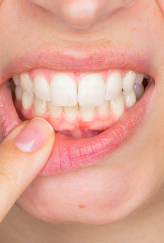 طرق علاج التهاب اللثة المزمن وكيفية الوقاية منها