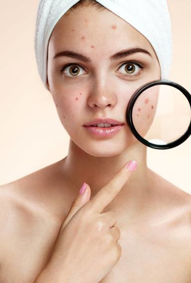 علاج حب الشباب للبشرة الجافة والحساسة