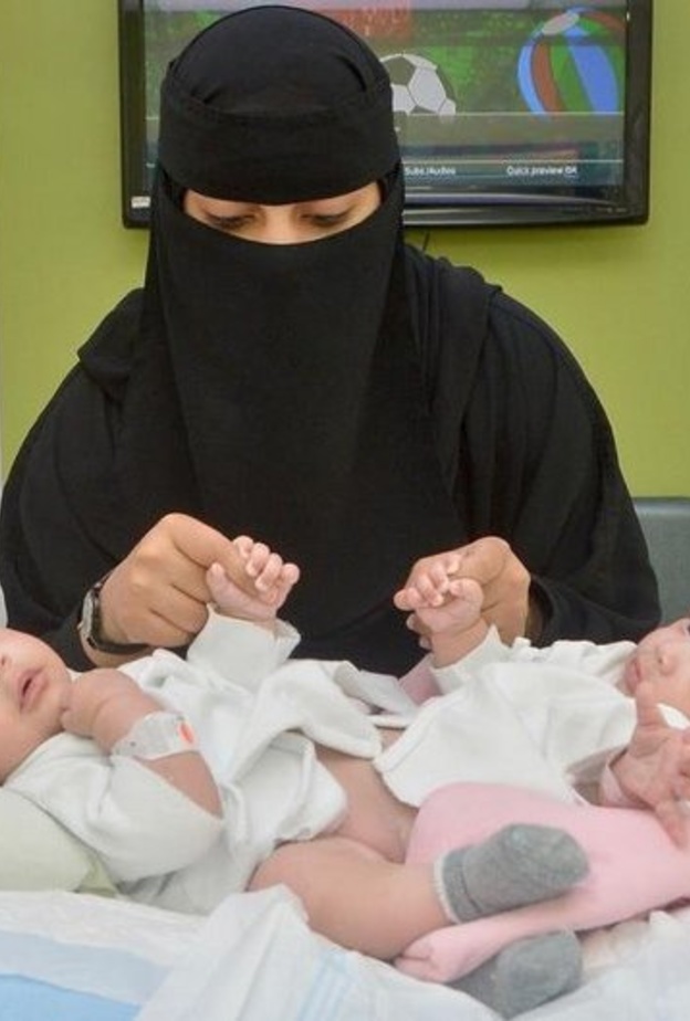 فصل التوأم السيامي السعودي شيخة وشموخ