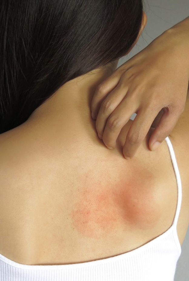 ماهو مرض الحزام الناري واهم اعراضه وطرق علاجه