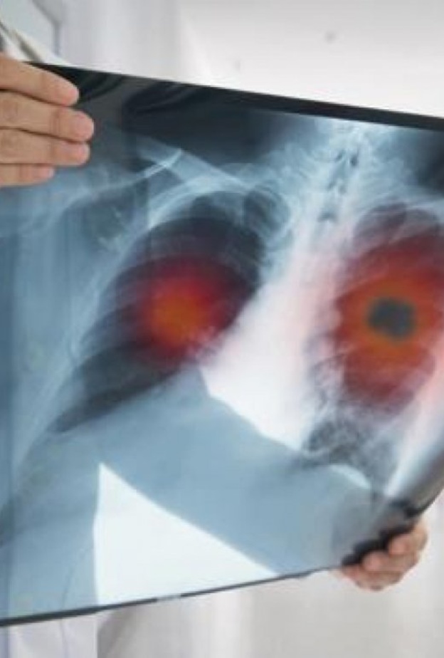 السعال المستمر أبرز أعراض سرطان الرئة