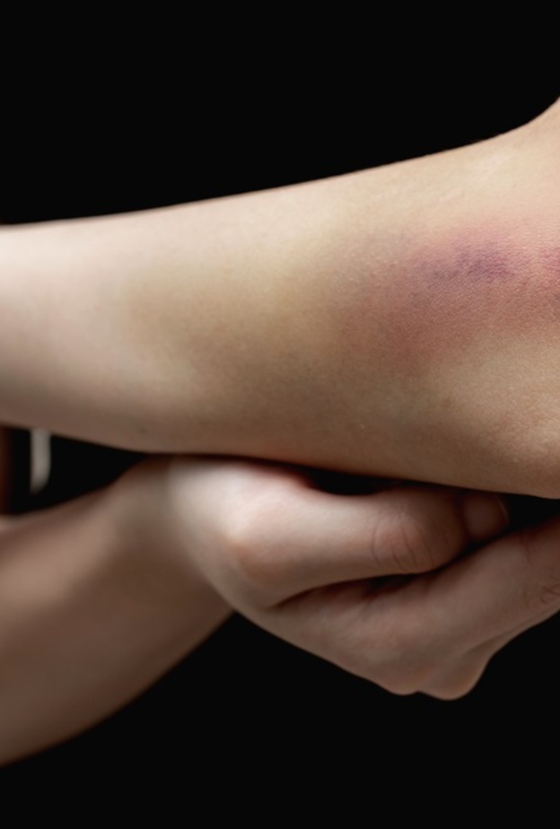  التقدم بالسن يتسبب بظهور كدمات على الجسم